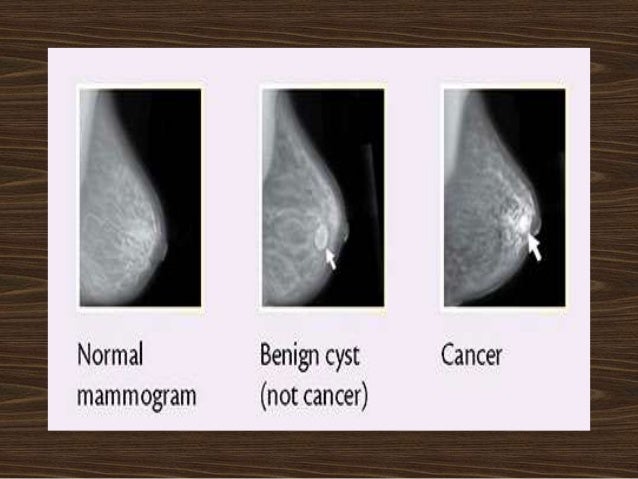 How to reset phone on iphone 7 plus touch screen Swelling under arm after breast cancer surgery